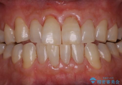 インビザラインでのマウスピース矯正中にPMTCで着色をきれいにの治療後