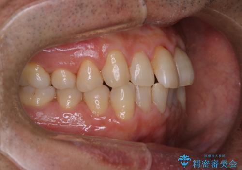 インビザラインでのマウスピース矯正中にPMTCで着色をきれいにの治療後