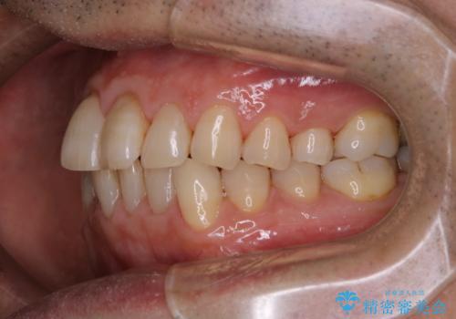 インビザラインでのマウスピース矯正中にPMTCで着色をきれいにの治療後