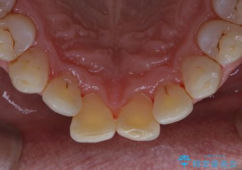 インビザラインでのマウスピース矯正中にPMTCで着色をきれいにの治療後