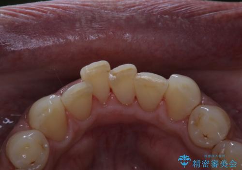 インビザラインでのマウスピース矯正中にPMTCで着色をきれいにの治療後