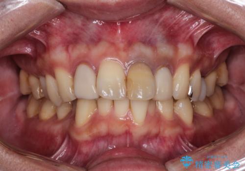 歯並びを含めて前歯をきれいにしたい　インビザラインとセラミック治療