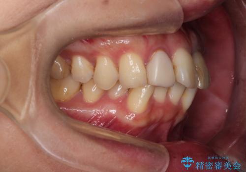 歯並びを含めて前歯をきれいにしたい インビザラインとセラミック治療の治療前