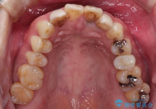 歯並びを含めて前歯をきれいにしたい インビザラインとセラミック治療の治療前