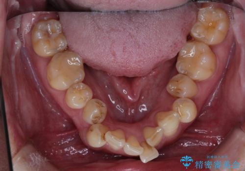 歯並びを含めて前歯をきれいにしたい インビザラインとセラミック治療の治療前