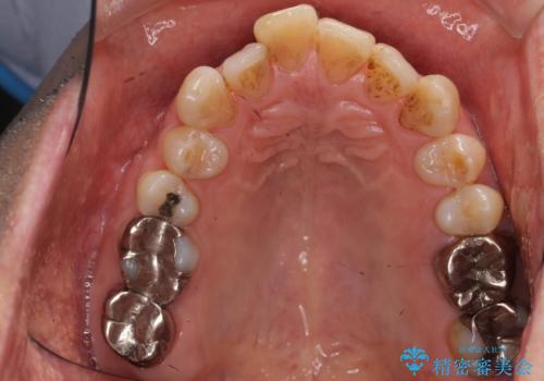 奥歯がわれている ソケットリフトを併用した奥歯のインプラント 60代男性の治療前