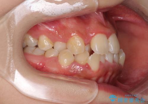 前後に重なった前歯 ワイヤー装置と急速拡大装置を併用したインビザライン矯正の治療前