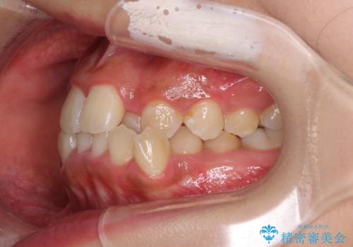 前後に重なった前歯 ワイヤー装置と急速拡大装置を併用したインビザライン矯正の治療前