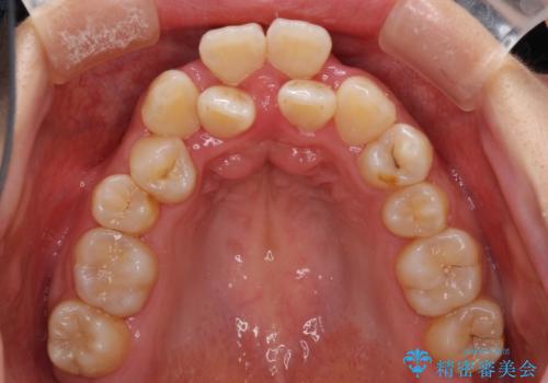 前後に重なった前歯 ワイヤー装置と急速拡大装置を併用したインビザライン矯正の治療前