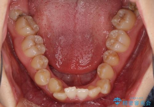 前後に重なった前歯 ワイヤー装置と急速拡大装置を併用したインビザライン矯正の治療前