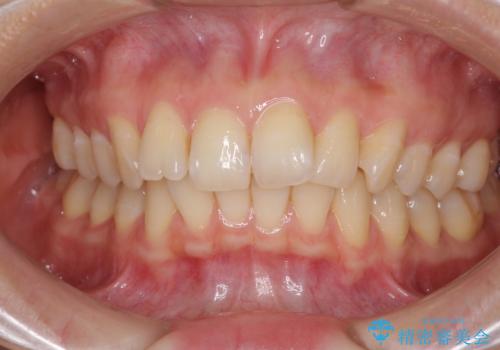 インビザラインによる矯正治療　カリエールディスタライザーを用いた奥歯の咬み合わせ改善の治療前