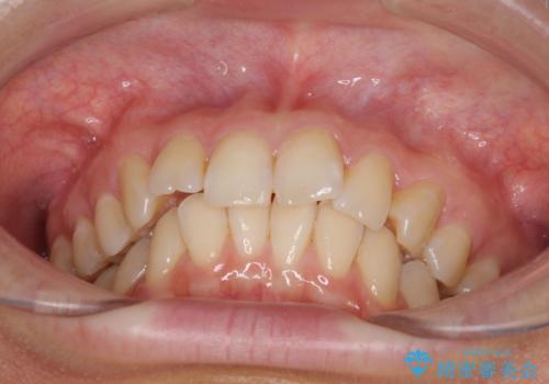 インビザラインによる矯正治療 カリエールディスタライザーを用いた奥歯の咬み合わせ改善の治療前