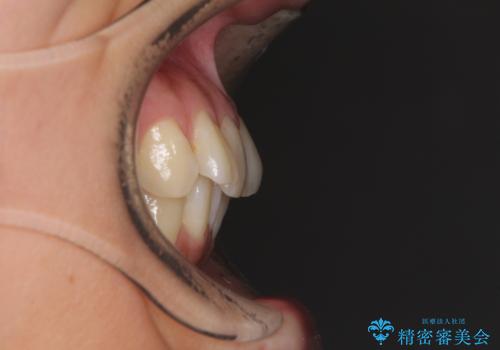 インビザラインによる矯正治療 カリエールディスタライザーを用いた奥歯の咬み合わせ改善の治療前