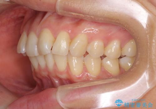 インビザラインによる矯正治療　カリエールディスタライザーを用いた奥歯の咬み合わせ改善の治療前