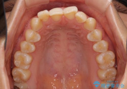 インビザラインによる矯正治療 カリエールディスタライザーを用いた奥歯の咬み合わせ改善の治療前
