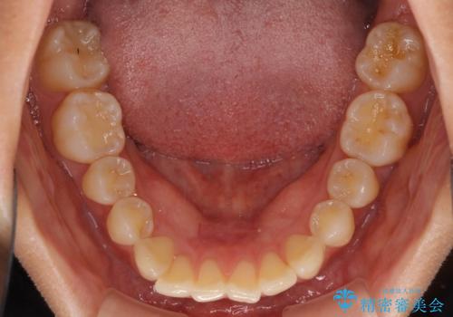 インビザラインによる矯正治療 カリエールディスタライザーを用いた奥歯の咬み合わせ改善の治療前