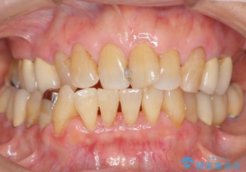 歯ぐきから血が出る、歯ぐきが腫れている　80代女性の症例 治療後