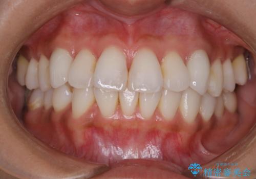 ホワイトニング前にPMTCで歯石取りの治療前