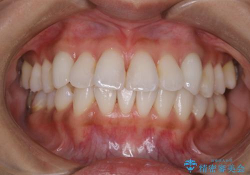 ホワイトニング前にPMTCで歯石取りの治療後