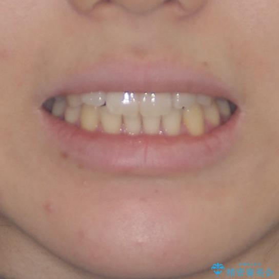 気になる前歯を整えたい インビザライン・ライトでの矯正治療の治療前(顔貌)