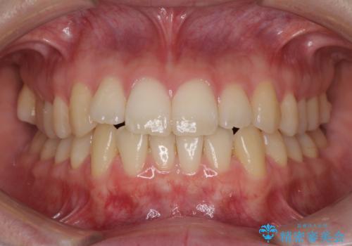 気になる前歯を整えたい インビザライン・ライトでの矯正治療の治療前