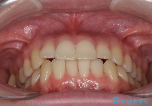 気になる前歯を整えたい インビザライン・ライトでの矯正治療の治療前