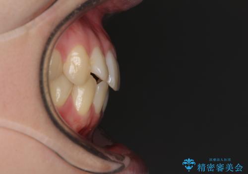 気になる前歯を整えたい インビザライン・ライトでの矯正治療の治療前