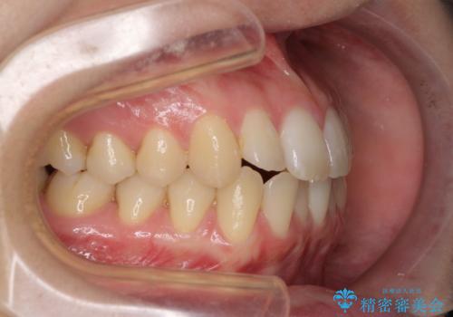 気になる前歯を整えたい インビザライン・ライトでの矯正治療の治療前