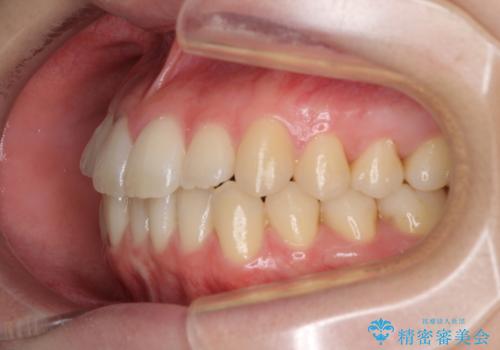 気になる前歯を整えたい インビザライン・ライトでの矯正治療の治療前