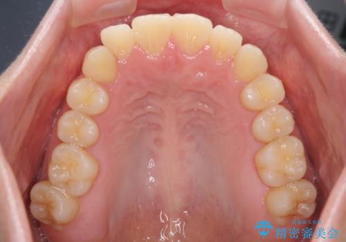 気になる前歯を整えたい インビザライン・ライトでの矯正治療の治療前