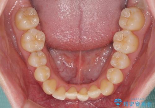 気になる前歯を整えたい インビザライン・ライトでの矯正治療の治療前