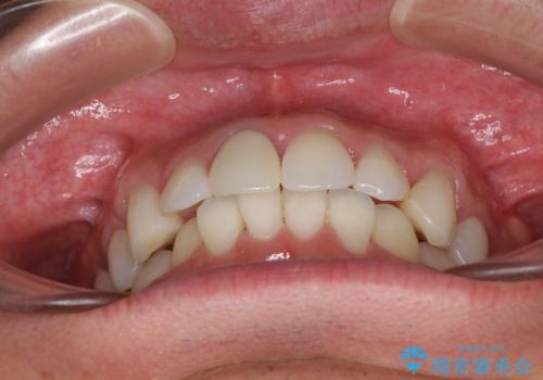 口が閉じにくい インビザラインによる矯正治療の治療前