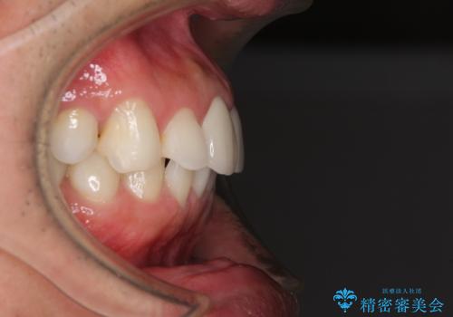 口が閉じにくい インビザラインによる矯正治療の治療前