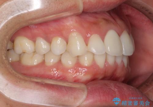 口が閉じにくい インビザラインによる矯正治療の治療前