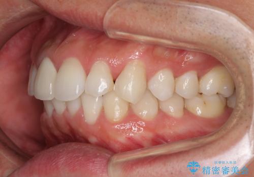 口が閉じにくい インビザラインによる矯正治療の治療前