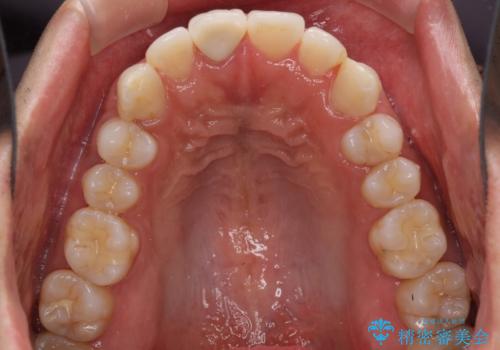 口が閉じにくい インビザラインによる矯正治療の治療前