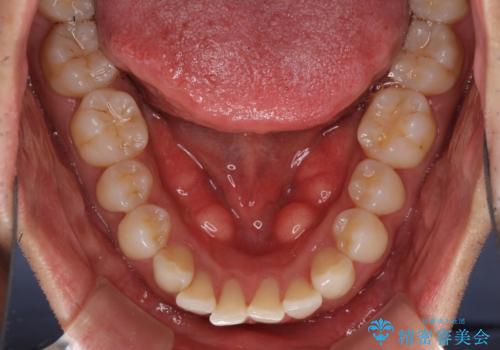 口が閉じにくい インビザラインによる矯正治療の治療前