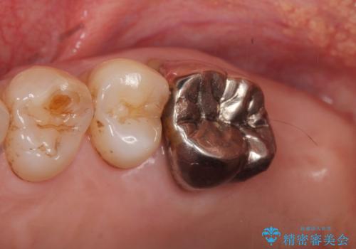 奥歯がわれている ソケットリフトを併用した奥歯のインプラント 60代男性の治療前