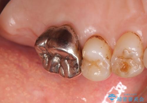 奥歯がわれている ソケットリフトを併用した奥歯のインプラント 60代男性の治療前