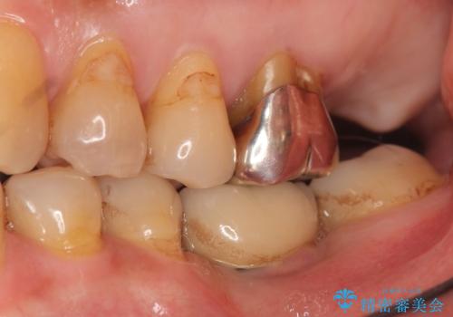 奥歯がわれている ソケットリフトを併用した奥歯のインプラント 60代男性の治療前