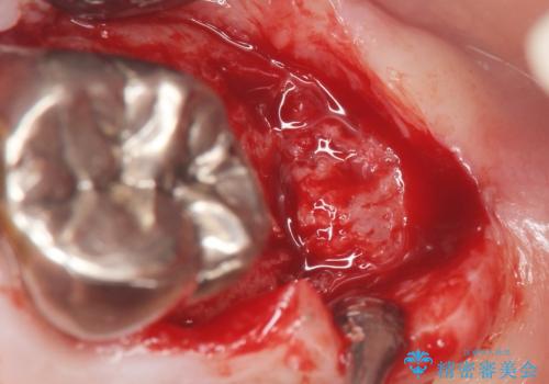 奥歯がわれている ソケットリフトを併用した奥歯のインプラント 60代男性の治療中