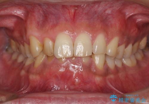 強い咬み合わせで削れた前歯 セラミッククラウンで自然な形にの治療前