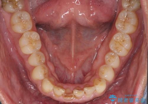 強い咬み合わせで削れた前歯 セラミッククラウンで自然な形にの治療前