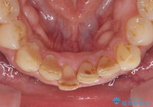 強い咬み合わせで削れた前歯 セラミッククラウンで自然な形にの治療前