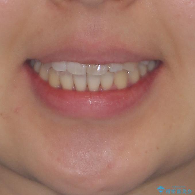 狭い上顎骨を拡大　著しい叢生を抜歯矯正で改善の治療後（顔貌）