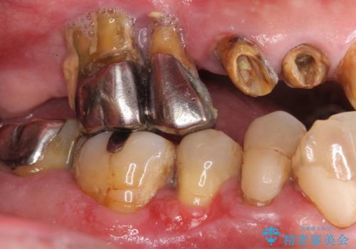 歯がぐらぐら　上顎洞底挙上術を併用した奥歯の<span class=