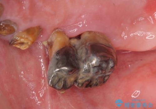 歯がぐらぐら 上顎洞底挙上術を併用した奥歯のインプラント 50代男性の治療前