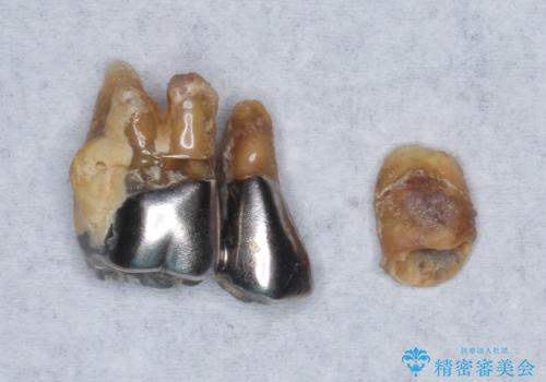 歯がぐらぐら 上顎洞底挙上術を併用した奥歯のインプラント 50代男性の治療前