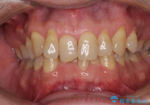歯根が露出している歯の歯肉移植 根面被覆術の治療前