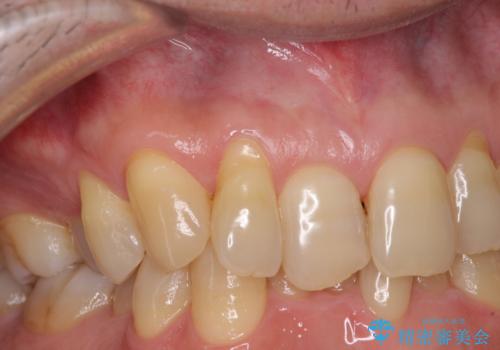 歯根が露出している歯の歯肉移植　根面被覆術の症例 治療前